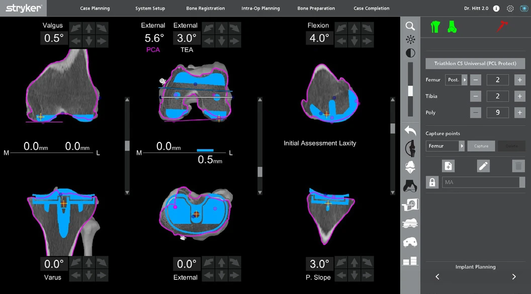 Mako Total Knee planning screenshot from Stryker case review