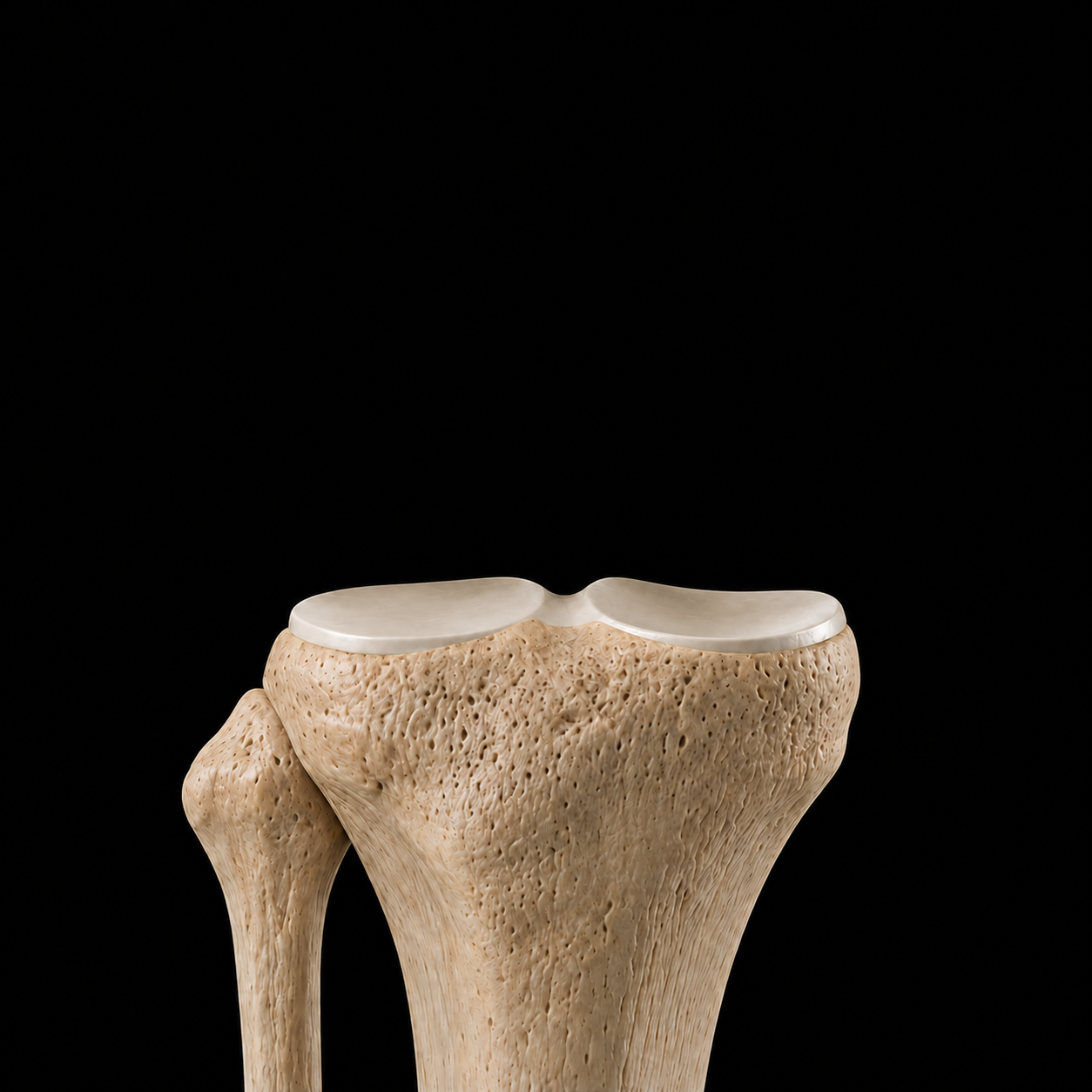 A front view of the shinbone and the joint surface, as a surgeon sees it on imaging
